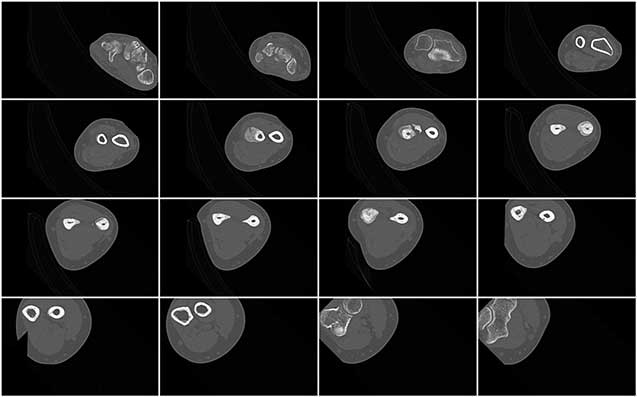 Montaged stack of CT images of a malunited forearm fracture which is very tilted